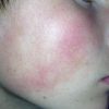 Gesichtshaut Gereizt? Allergie? Rosazea? (Haut, Gesicht, Hautpflege) für Hautpilz Kinder Bilder