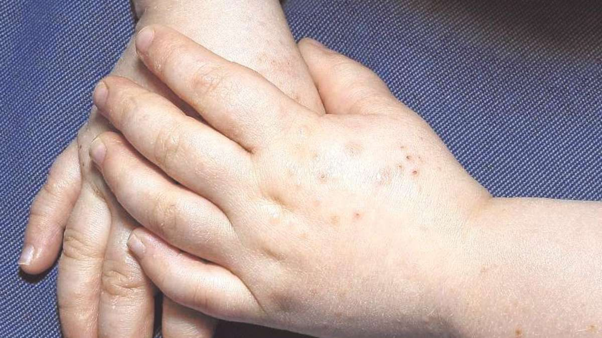 Hand-Fuß-Mund-Krankheit: Schwere Fälle Sind Selten | Rotenburg / Bebra bei Ausschlag Kinder Bilder