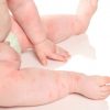 Hautausschlag Baby Ganzer Korper - Ganzer 2020 bei Exanthem Kinder Bilder