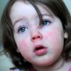 Hautausschlag Bei Baby Und Kind - Was Ist Das? - Familie.de in Hautpilz Kinder Bilder