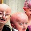 Hutchinson-Gilford-Syndrom || Med-Kom innen Progerie Kinder Bilder