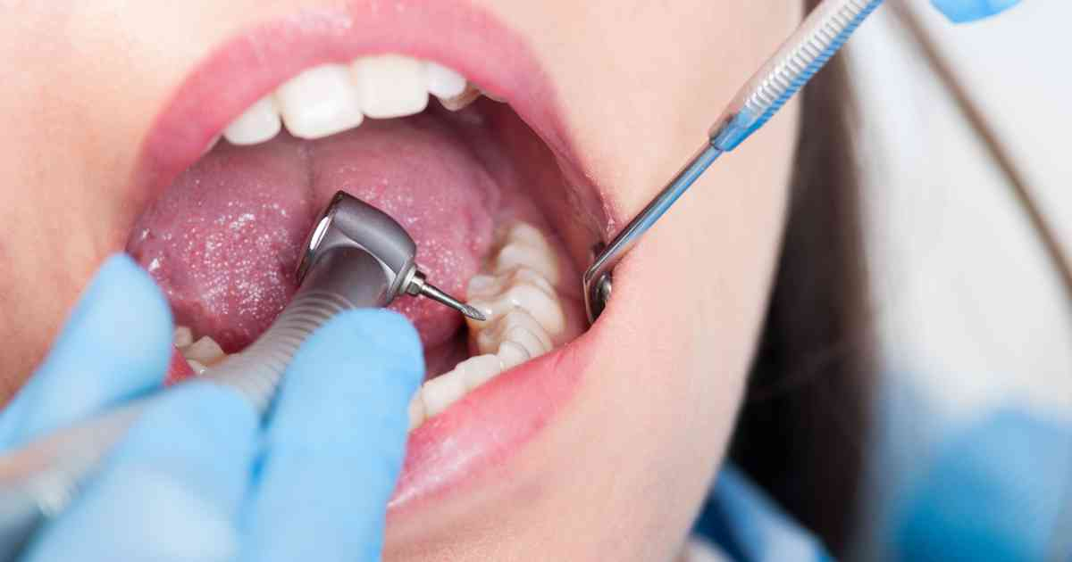 Karies-Behandlung Ohne Bohren - So Funktioniert Die Neue Methode für Faule Zähne Kinder Bilder