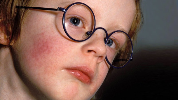 Kinderkrankheiten: Ringelröteln bei Scharlach Symptome Kinder Bilder