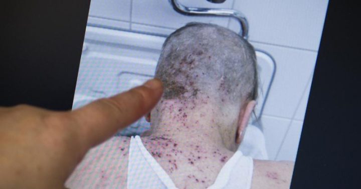 Krätze Möglichst Sofort Behandeln | 1&1 bei Kinder Krätze Bilder Krätze Möglichst Sofort Behandeln | 1&1 bei Kinder Krätze Bilder