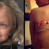 Krebsüberlebende 8-Jährige Lernt Narben Zu Lieben bestimmt für Leistenbruch Kinder Bilder
