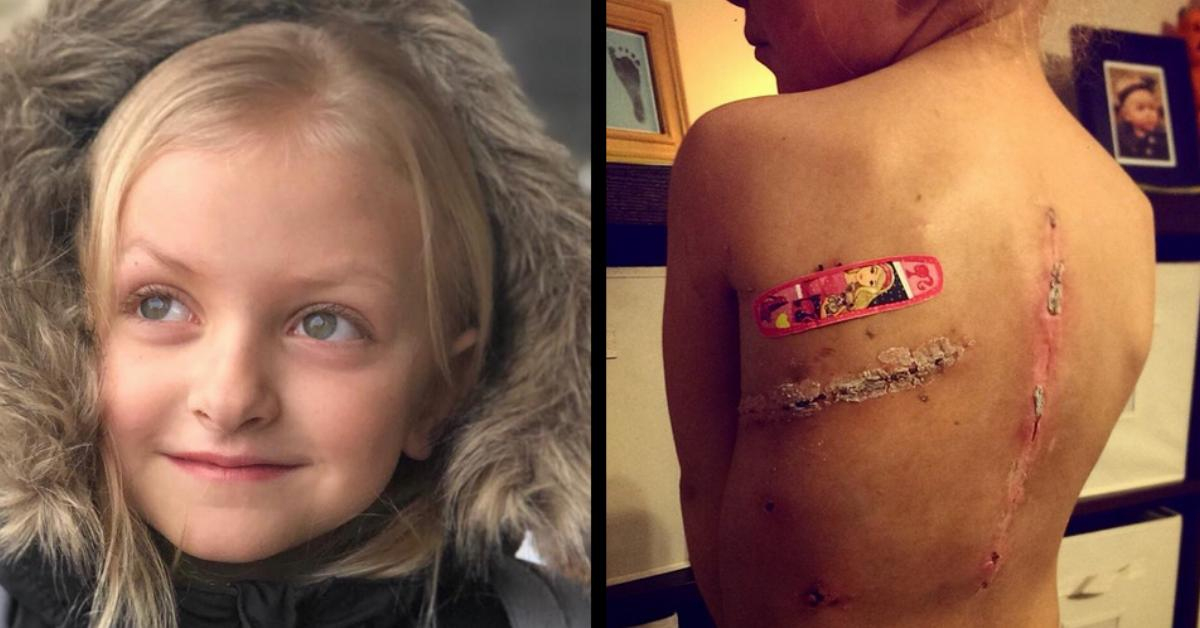 Krebsüberlebende 8-Jährige Lernt Narben Zu Lieben bestimmt für Leistenbruch Kinder Bilder