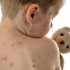 Masern, Mumps Oder Röteln: Kinderkrankheiten Bloß Nicht Unterschätzen über Ausschlag Kinder Bilder