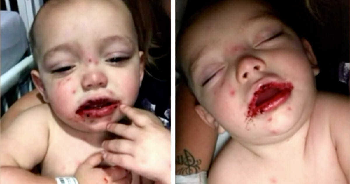 Mutter Sieht Blasen Im Mund Ihres Babys - Diagnose Zerstört Ihr Leben verwandt mit Hand Mund Fuß Krankheit Kinder Bilder