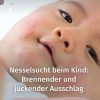 Nesselsucht Beim Kind: Brennender Und Juckender Ausschlag In 2020 verwandt mit Kinder Hautkrankheiten Bilder