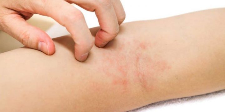 Neurodermitis: Betroffene Jugendliche Psychisch Unterstützen - Heilpraxis in Krätze Kinder Bilder