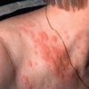 Rote Flecken Auf Der Stirn Ohne Juckreiz - Rote Flecken Ohne Jucken Und bei Kinder Hautausschlag Bilder