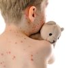 Scharlach: Was Sie Außer Dem Antibiotikum Noch Tun Können mit Kinder Hautausschlag Bilder