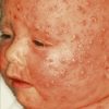 Schutzimpfungen verwandt mit Scharlach Kinder Bilder