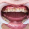 Schützt Fluorid Wirklich Unsere Zähne Vor Karies? - Life Goes On Tv bestimmt für Karies Zähne Kinder Bilder