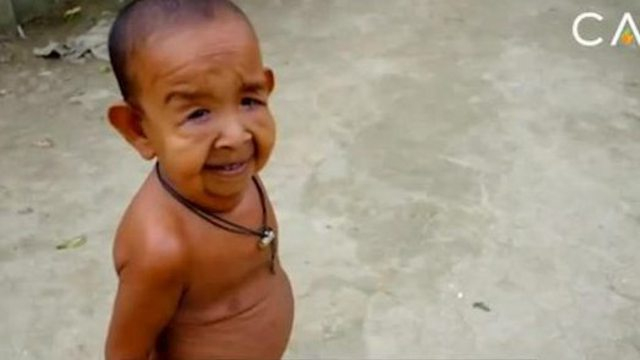 Seltene Krankheit: Junge (4) Sieht Aus Wie Ein Alter Mann - Mit Video mit Progerie Kinder Bilder