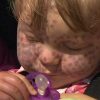 Sturge-Weber-Syndrom: Matilda Hat Rote Flecken Im Gesicht - Rtl.de bei Progerie Kinder Bilder