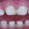 Thema Karies | Magic Dental bestimmt für Faule Zähne Kinder Bilder