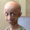 Unheilbar Krank: Seite 2: Warum Gamze Nicht Weiß, Dass Sie Früher bei Progerie Kinder Bilder