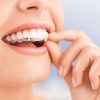 Unsichtbare Zahnkorrektur | Dr. Wegner - Praxis Für Zahnheilkunde bestimmt für Kreuzbiss Kinder Bilder