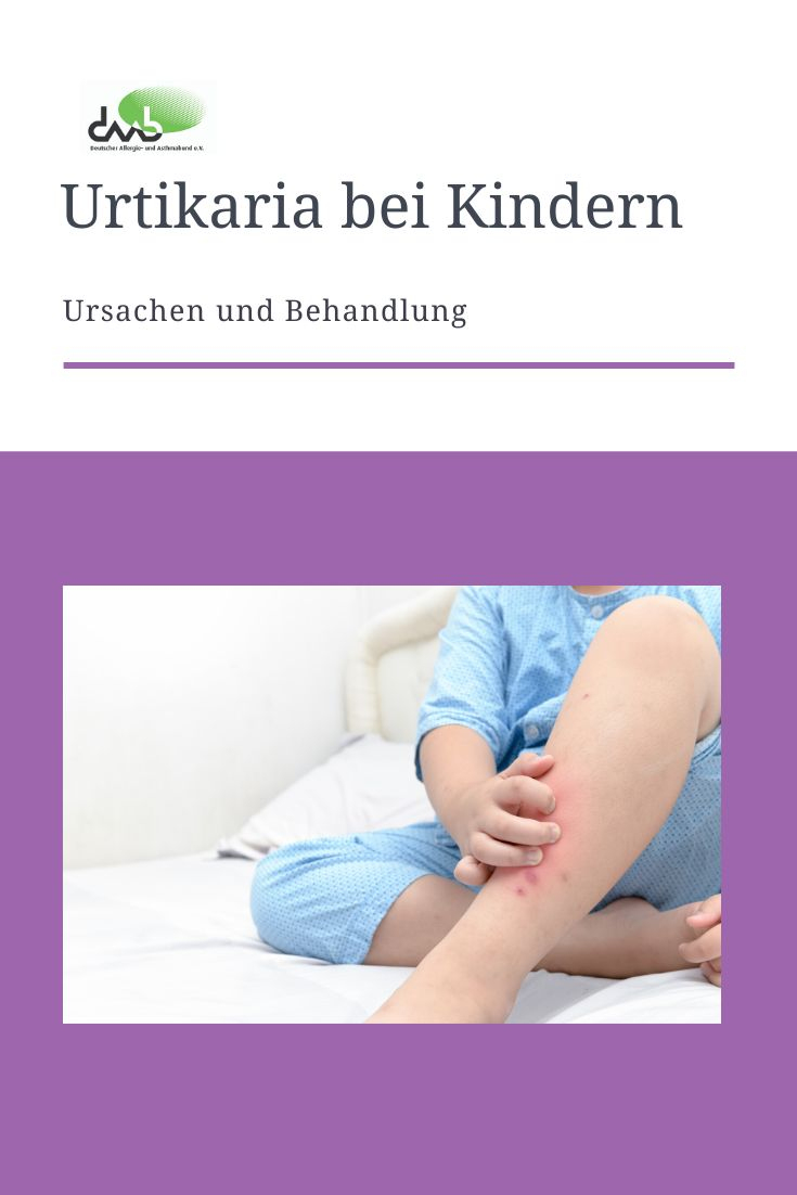 Urtikaria Bei Kindern | Nesselsucht Ursachen, Nesselsucht, Kinder in Kind Nesselsucht Bilder