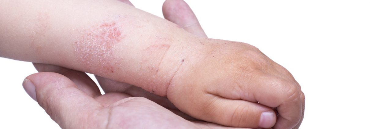 Wenn Kinder Unter Neurodermitis Leiden - Babymarkt.de ganzes Kinder Hautkrankheiten Bilder