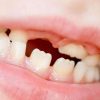 Wie Kinder Den Zahnverlust Empfinden | Magazin verwandt mit Bilder Kinder Mit Schlechten Zähnen