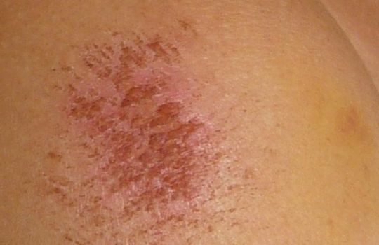 Wunden Natürlich Behandeln - Phytodoc bei Kinder Hautkrankheiten Bilder