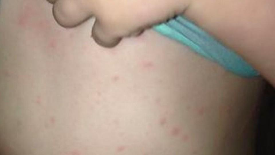 Wundrose: Mutter Warnt Vor Gefährlichem Ausschlag mit Kinder Hautausschlag Bilder