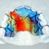Zahnregulierung Und Zahnspangen In Tirol - Zahnregulierung Tirol Beim bestimmt für Kreuzbiss Kinder Bilder