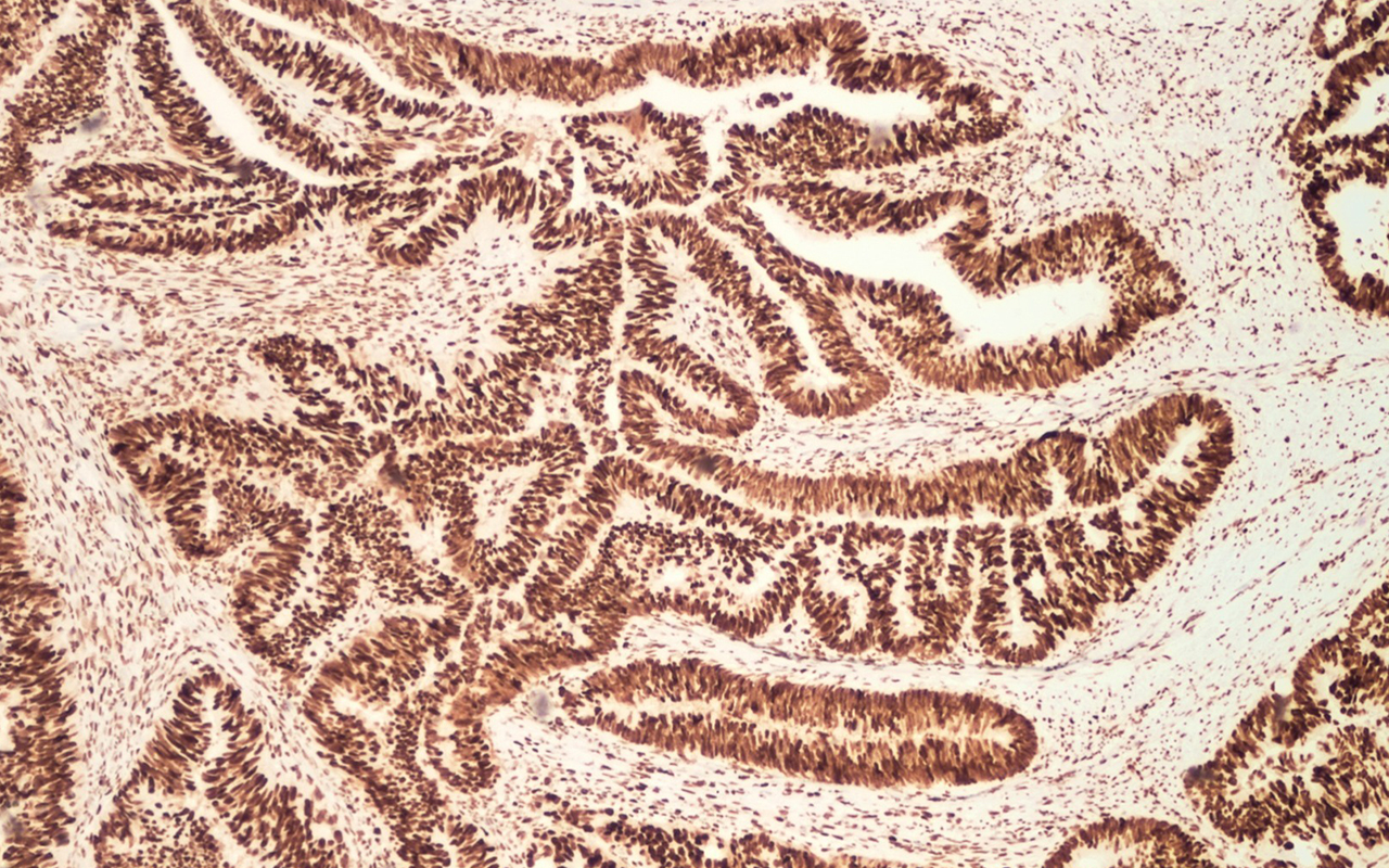 Lynch syndrome: the cancer risk nobody’s heard of | InSight+